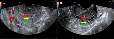 Analysis of clinical data of different endometrial pathological types in perimenopausal women with abnormal uterine bleeding